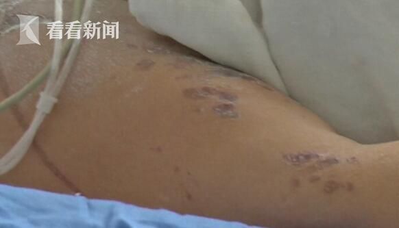 
B&agrave; Ho&agrave;ng Quế Thanh (69 tuổi) bị con trai đổ axit l&ecirc;n người dẫn đến m&ugrave; 2 mắt.
