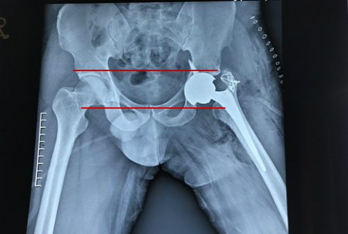 Sau phẫu thuật ổ cối và đầu khớp đã nằm cân đối trên một trục.
