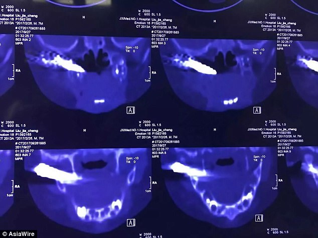 Sau khi chụp CT, b&aacute;c sĩ ph&aacute;t hiện đầu mũi t&ecirc;n bằng kim loại d&agrave;i 4 cm l&uacute;n s&acirc;u b&ecirc;n trong m&aacute; nạn nh&acirc;n.