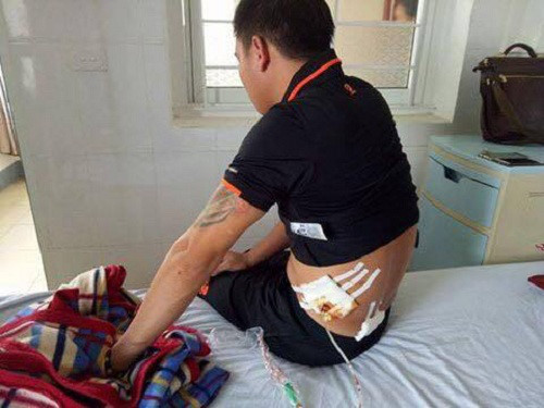 Một nạn nh&acirc;n bị thương đang điều trị tại bệnh viện. Ảnh: N.A.