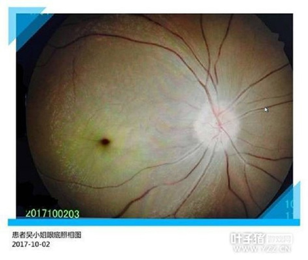 
Hình ảnh chụp mắt phải của Wu cho thấy đồng tử bị giãn.
