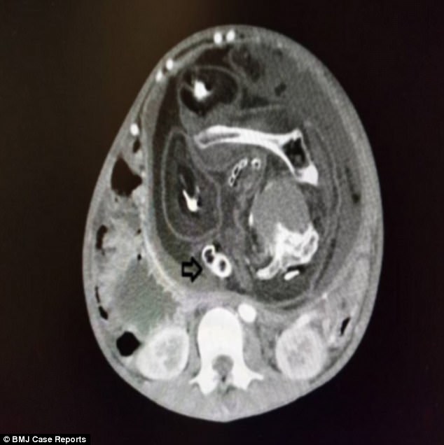 
Ảnh chụp cắt lớp bào thai người anh em song sinh trong bụng thiếu niên 15 tuổi.
