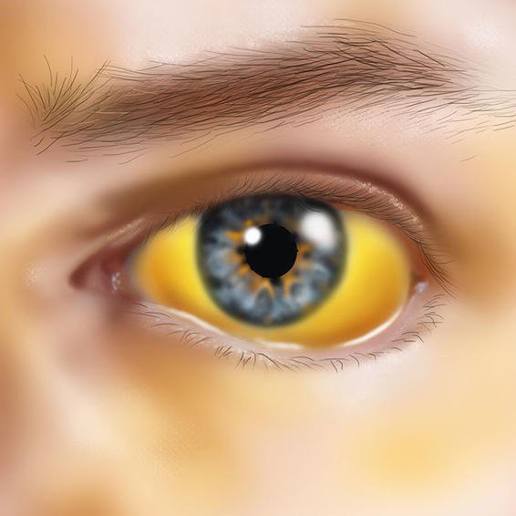 
Gan bị bệnh sẽ càng làm bilirubin xuất hiện nhiều máu, từ đó dẫn đến da và mắt bị vàng.
