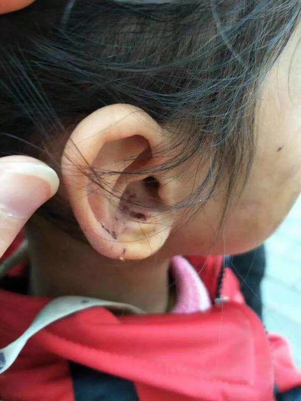 Những vết m&aacute;u đ&atilde; đ&ocirc;ng lại trong lỗ tai.