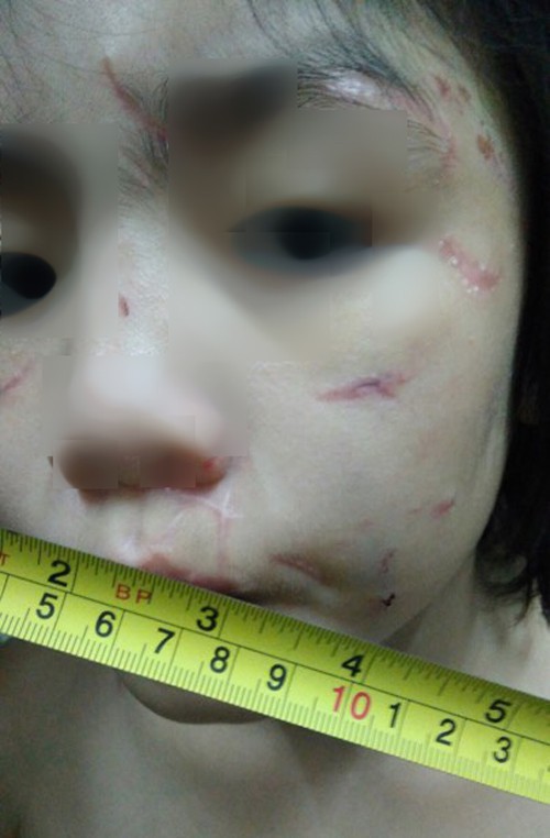 
Vết tích của những lần bị bạo hành trên mặt bé trai 10 tuổi - Ảnh: CAND
