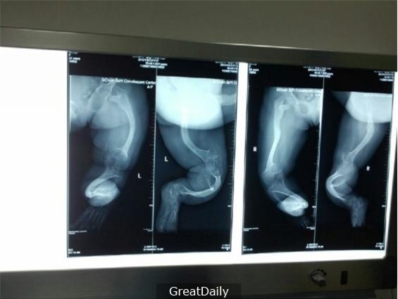 
Qua kết quả chụp X-quang cho thấy xương bàn chân của bé có dấu hiệu bị cong.
