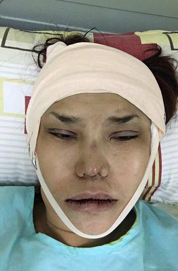 
Sau 7 tiếng trong phòng phẫu thuật, Cindy Thái Tài được bác sĩ Võ Thành Trung cắt mí mắt, kéo dài mũi, lấy chất làm đầy ra khỏi môi và tạo hình lại khuôn miệng theo mốt môi mèo đang rất hot. Vừa tỉnh dậy sau ca phẫu thuật, cô dùng điện thoại ghi lại diện mạo mới ngay.
