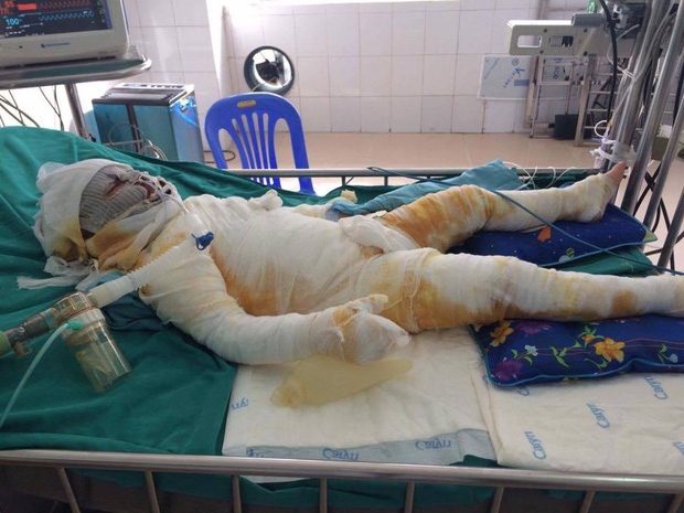 B&eacute; L&acirc;m h&ocirc;n m&ecirc; s&acirc;u sau khi bị cả lọ cồn văng v&agrave;o người.