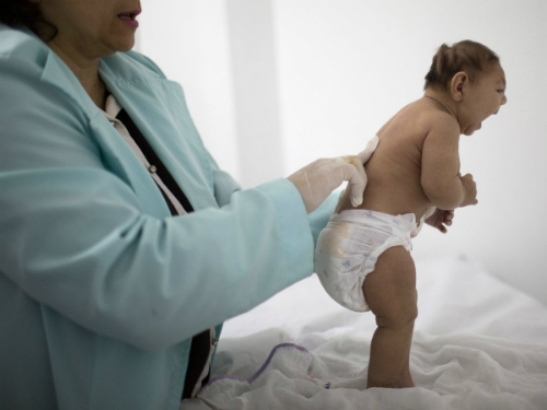 
Một em bé bị bệnh đầu nhỏ do virus Zika. 
