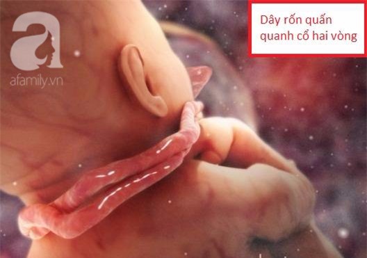 
Em bé với 2 vòng dây rốn quấn quanh cổ.
