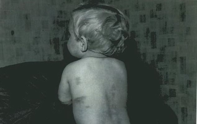 Trên người bé Paul trước khi tử vong có rất nhiều vết bầm tím.