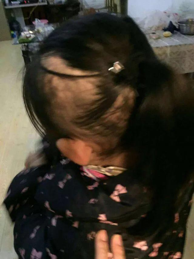 T&oacute;c tr&ecirc;n đầu b&eacute; g&aacute;i gần như đ&atilde; bị rụng mất 1 nửa nhưng người mẹ n&oacute;i l&agrave; kh&ocirc;ng c&oacute; thời gian đưa con đi kh&aacute;m.