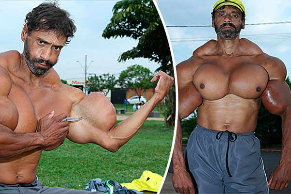 
Thậm chí, synthol còn tiếp cận với người bình thường. Một công nhân sống tại Sao Paulo, Brazil có tên Valdir Segato trở nên nổi tiếng khi tăng kích cỡ cơ bắp của mình lên gấp đôi. Valdir Segato cho biết được truyền cảm hứng từ diễn viên Arnold Schwarzenegger và nhân vật Người khổng lồ xanh.
