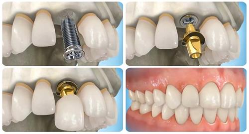 
Kỹ thuật cấy ghép Implant phục hồi răng mất
