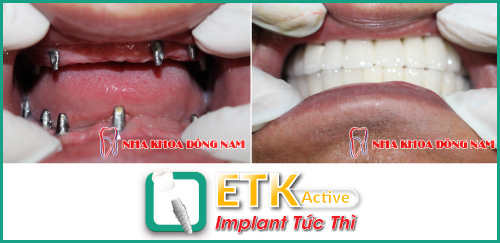 
(Implant ETK Active giúp tiết kiệm thời gian trồng răng giả cho bệnh nhân)
