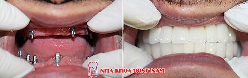 
Cấy ghép Implant giúp phục hồi lại tính thẩm mỹ cho khuôn mặt
