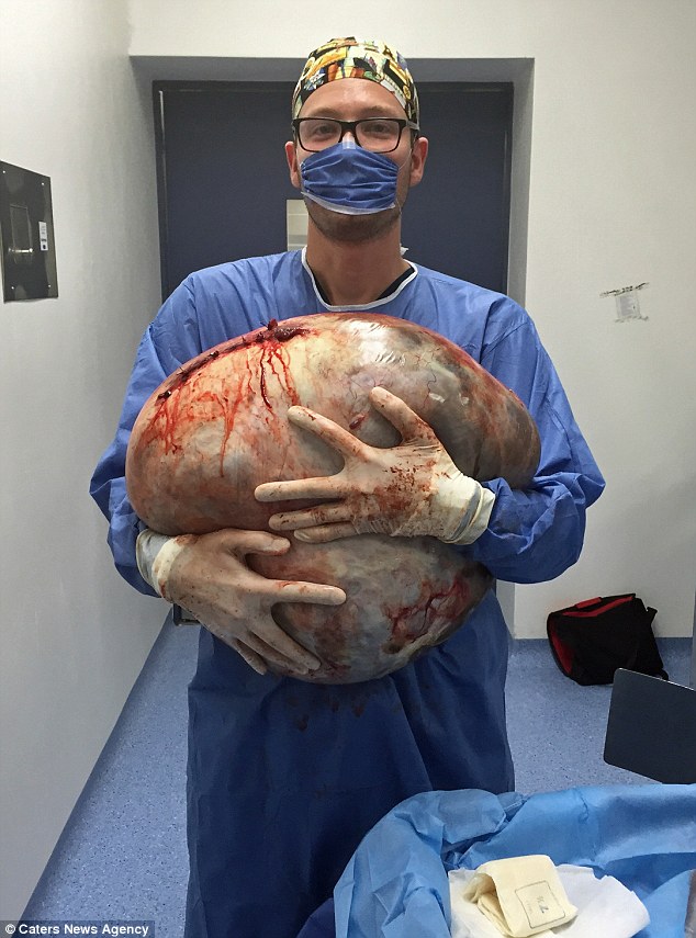 
Bác sĩ phẫu thuật Erik cho biết đây là khối u lớn nhất mà anh từng phẫu thuật.
