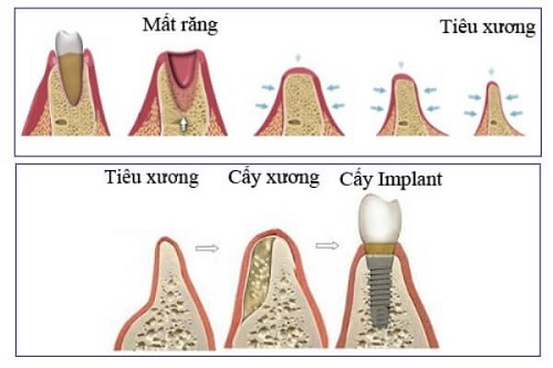 
(Trồng răng Implant giúp giữ vững mô xương hàm)
