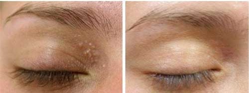 Mụn thịt sẽ nhanh chóng biến mất