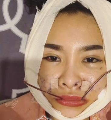 
Quế Vân gây sốc khi tung hình ảnh phẫu thuật thẩm mỹ khuôn mặt
