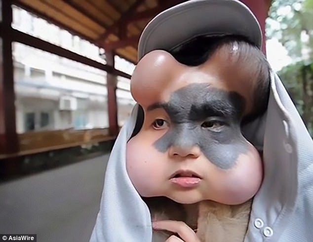 
Gương mặt biến dạng khi điều trị của c&ocirc; g&aacute;i trẻ Xiao Yan.
