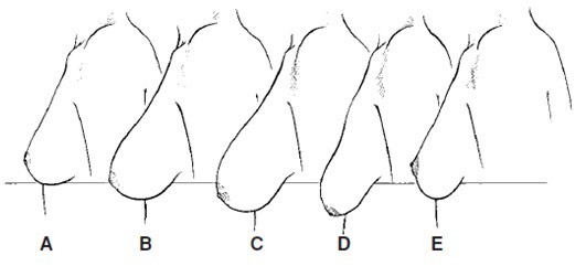 
Vòng ngực chảy sệ sau sinh.
