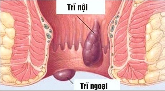 Trĩ nội, trĩ ngoại đều khiến người bệnh gặp khó khăn trong sinh hoạt.