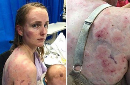 Fiona bị thương khi che chắn cho con gái và bà trong trận mưa đá hôm 11/10 ở bang Queensland, Australia. Ảnh: Twitter.