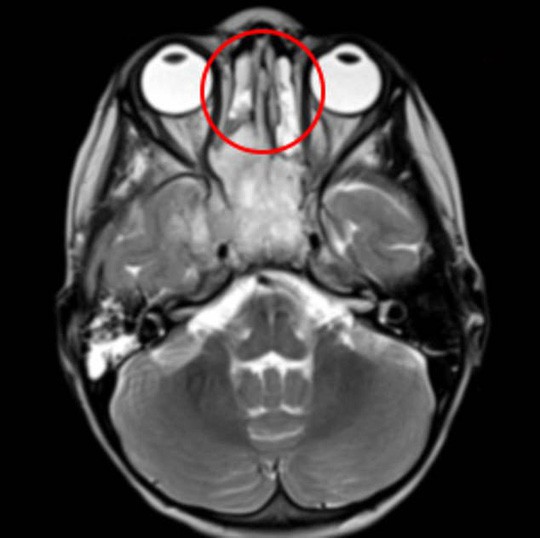 
Khối u (khoanh tròn đỏ) được thể hiện trong phim MRI - ảnh do bệnh viện cung cấp.
