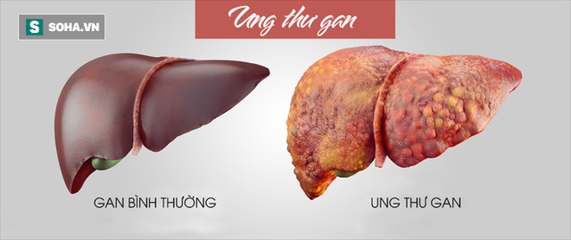
Ung thư gan tại Việt Nam đang tăng ở cả hai giới.
