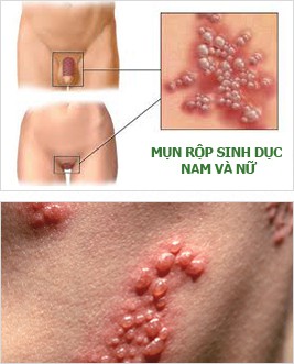 Mụn rộp sinh dục ở nam và nữ có thể gây vô sinh.