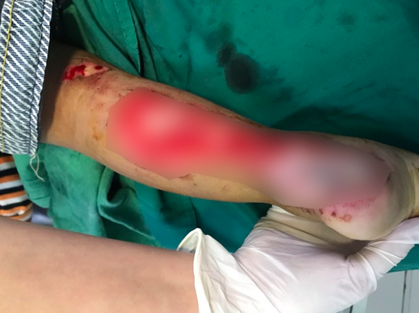 Chân trái của bé Kh bị đứt gân, vết thương khuyết da, mất da ở vùng nguy hiểm, lộ xương gót chân.