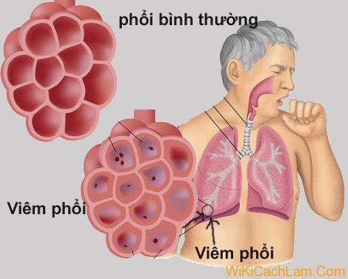 
Dấu hiệu của viêm phổi ở người cao tuổi rất khác so với người trẻ.
