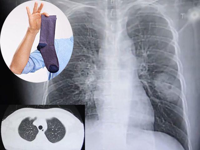 
Hình chụp X quang cho thấy ông Bành bị nấm phổi

