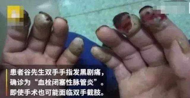 
Các đầu ngón tay của bệnh nhân đã chuyển sang màu đen, gần như bị hoại tử
