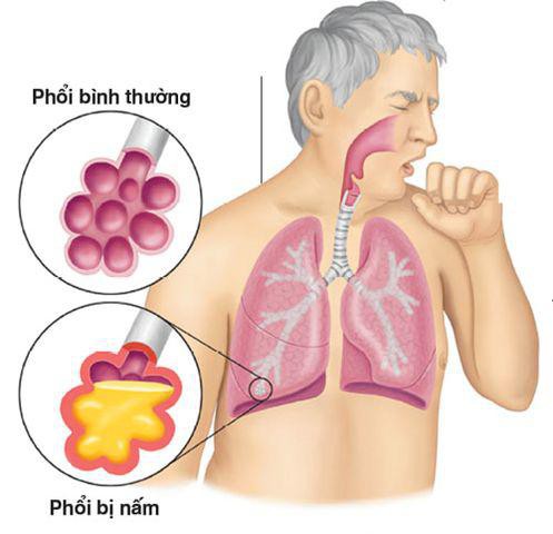 
Những người có sức đề kháng kém thường rất dễ bị nấm phổi
