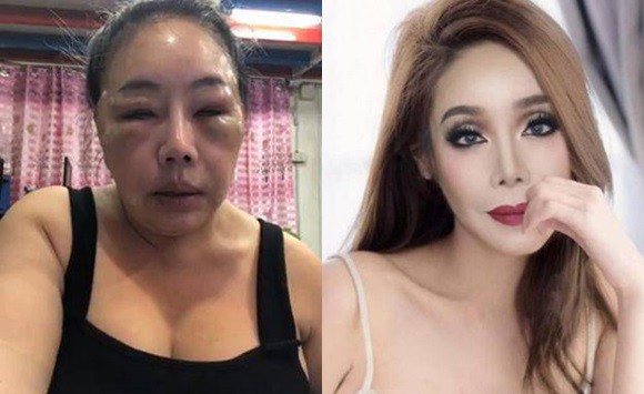 H&igrave;nh ảnh về việc thẩm mĩ với mục đ&iacute;ch trẻ đẹp hơn để tranh cử Thủ tướng của nữ đại gia cũng bị cư d&acirc;n mạng xứ Ch&ugrave;a V&agrave;ng chỉ tr&iacute;ch thậm tệ.