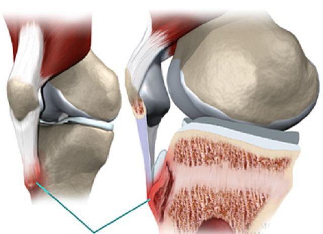 
Ung thư xương cũng có liên quan tới việc vận động quá mức
