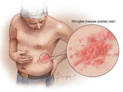 
Biểu hiện của bệnh zona là các triệu chứng: sốt, đau rát da, xuất hiện mụn nước. Ảnh minh họa.
