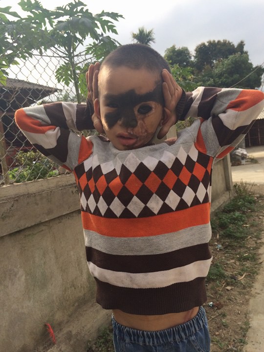 
Vừa rồi, b&eacute; L&ecirc; Bảo Trọng được tiến h&agrave;nh phẫu thuật khu&ocirc;n mặt (ảnh gia đ&igrave;nh cung cấp)
