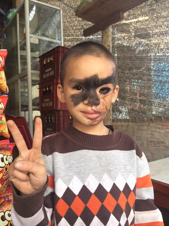 
Giờ đ&acirc;y, anh Phấng, chị Nhất hạnh ph&uacute;c hơn bao giờ hết bởi kh&ocirc;ng c&ograve;n nỗi lo về việc khu&ocirc;n mặt đen sẽ ảnh hưởng đến cuộc sống của con m&igrave;nh (ảnh gia đ&igrave;nh cung cấp)
