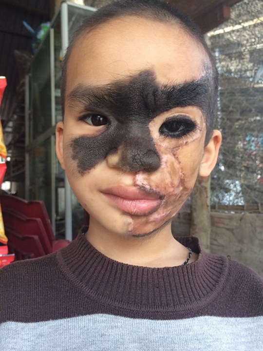 
Chị Nhất cho biết, b&eacute; Trọng sẽ tiến h&agrave;nh 2 cuộc phẫu thuật trong thời gian tới (ảnh gia đ&igrave;nh cung cấp)
