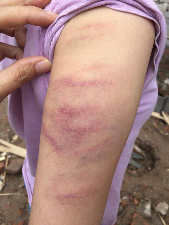 Học sinh Trường tiểu học Mễ Trì bị cô giáo đánh thâm tím tay vì làm thiếu bài tập.