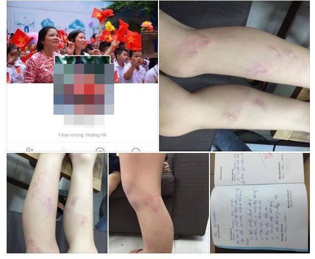 Cháu M.Đ, Trường tiểu học Nguyễn Tri Phương (Hà Nội) bị đánh bầm tím chân vì vào lớp muộn sau giờ ra chơi.