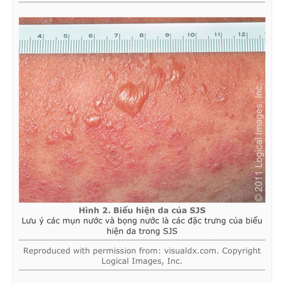 Biểu hiện da đặc trưng của hội chứng hiếm gặp này