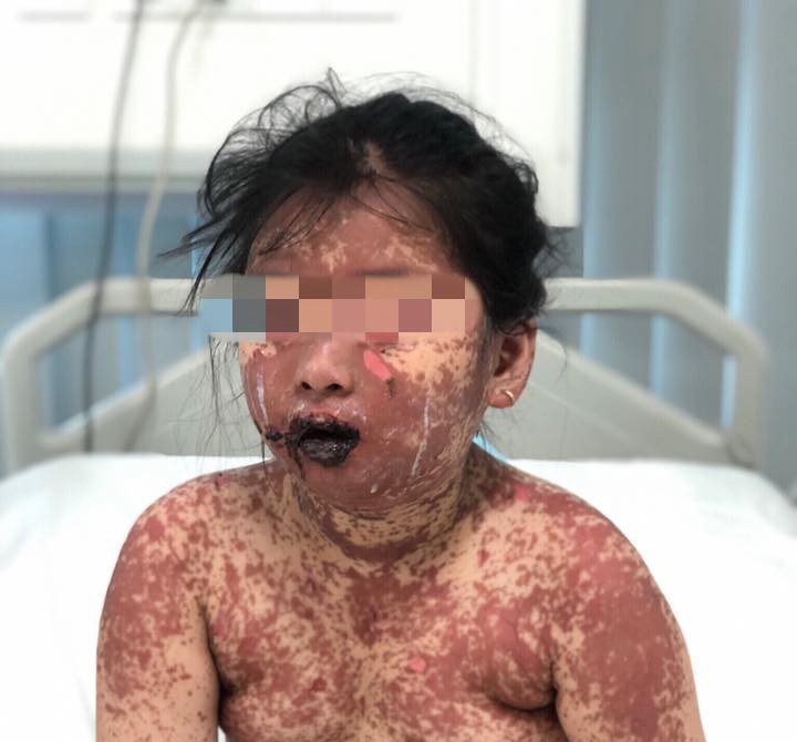 Bé N mắc hội chứng hiếm gặp sau khi uống thuốc không rõ loại