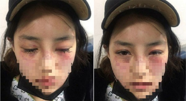 Gương mặt bị đánh đập đến bầm tím, sưng húp của B.