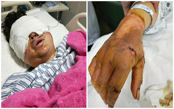 Cô Song bị thương nghiêm trọng.