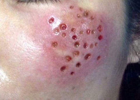 Ảnh một bệnh nhân bị hỏng da do laser không đúng kỹ thuật