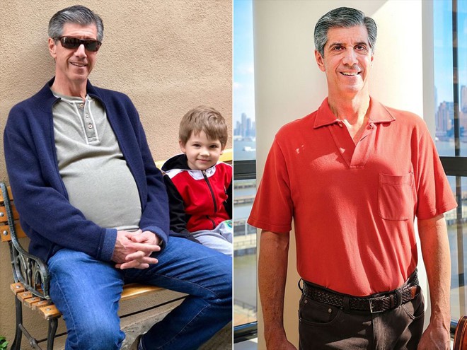 Ông Daly trước và sau khi phẫu thuật cắt khối u. Ảnh: People.